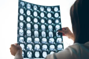 Onchocerca volvulus and epilepsy: A comprehensive review using the Bradford Hill criteria for causation